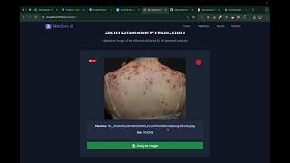 AI Skin Cancer Detection System | Deep Learning Project | Python