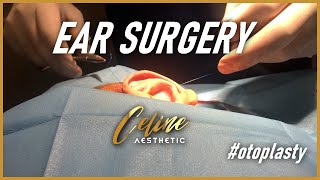 How Does Otoplasty Surgery Performed? - Celine Aesthetic #otoplastia #otoplasty #earsurgery