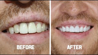 Cosmetic Dentistry ( Smile Makeover with Zirconium Crowns ) - ILya from the UK