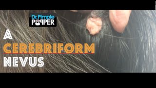 Dermatology: Removing a cerebriform nevus on the scalp