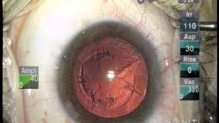 Ravi Goel MD - Part V - Live Cataract Surgery - Patient Friendly