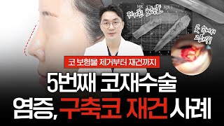 5번째 구축코재수술｜코수술 후 염증으로 콧 속에서 고름이?!😮｜코 실리콘, 기증늑연골 제거부터 코재건 사례