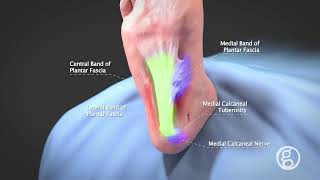 Plantar Fascia Release with MicroAire SmartRelease - Ghost Productions Medical Animation