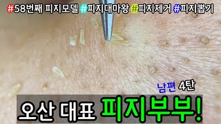 피지 직접 뽑아드렸습니다 _ 피지제거 블랙헤드제거 피지뽑기 _  오산 피지부부 먼저 남편 피지짱 먼저 피지를 박살냈습니다 4탄