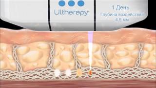 Как работает Альтера (Ulthera)