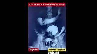 ? Diagnosis - Double contrast barium enema  -Practice case with Answer - ? Description