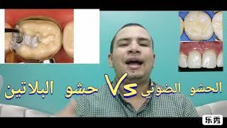 ايهما افضل  الحشوات الضوئيه( حشو الليزر) ام الحشوات الفضيه(حشو البلاتين) ؟