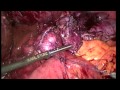 laparoscopic lysis of adhesions and redo of gastrojejunostomy after gastric bypass