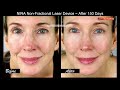 NIRA Precision Laser Review  Before & After 150 Days!