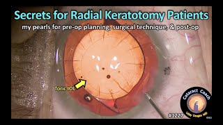 Cataract 1227: secrets for radial keratotomy patients having cataract surgery