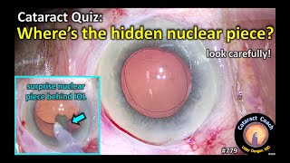 Cataract Quiz: Where is the hidden nuclear piece in cataract surgery?