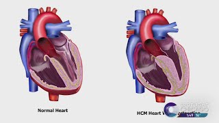 Hypertrophic Cardiomyopathy Awareness Day