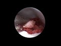 what to expect with knee arthroscopy scottish rite hospital sports medicine