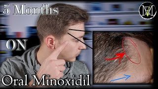 Oral Minoxidil (Loniten) Results in 5 Months