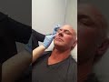 mike s botox treatment w before u0026 after photos