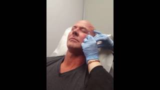 Mike's Botox Treatment w/Before \u0026 After Photos