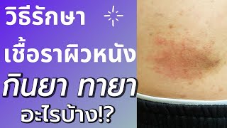 รักษาโรคเชื้อราที่ผิวหนัง - ต้องทายา กินยาอะไรบ้าง?