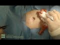 open umbilical hernia repair at california hernia specialists 4k