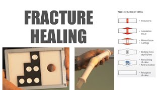 Skills Lab : Mechanism Fracture healing