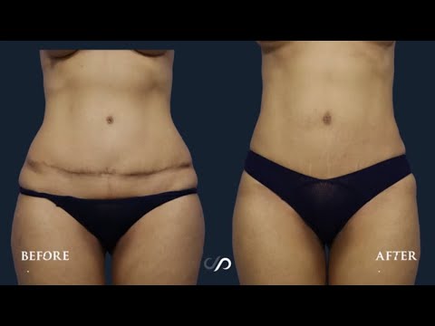Does a tummy tuck lift your pubic area?