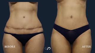 Revision Tummy Tuck & Pubic Lift | Before and After | Dr. David Stoker