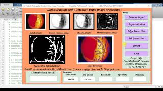 Matlab Code for Diabetic Retinopathy Detection Using Image Processing Full Source Code