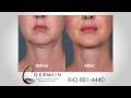 Germain Dermatology Introduces Kybella