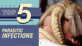 TOP 5 Parasitic Infections