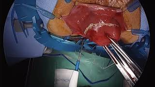 A New Approach for Rectal Prolapse: Perineal Proctectomy with TAMIS Rectopexy and Mesh Fixation