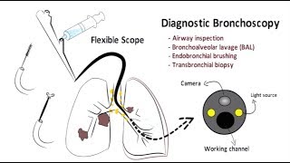 Introduction to Interventional Pulmonary for Students and Residents -- BAVLS