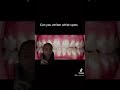 Whitening white spots #shorts #braces #orthodontist #teeth #invisalign