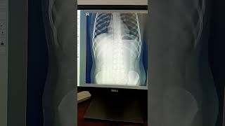 X ray abdomen erect # normal please subscribe