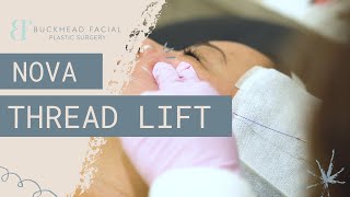 NovaThreads Infinity Thread Lift | PDO Threads for Jawline Contouring