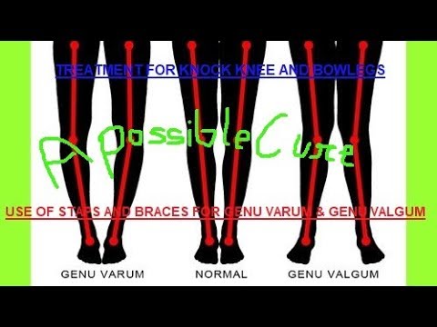 Possible Cure For Knock Knee, Bowlegs, Genu Varum, Genu Valgum - YouTube