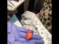 Lipoma Pop