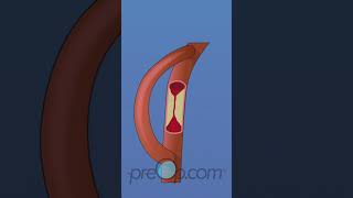 "🚑 Coronary Artery Bypass Graft Explained: Heart Surgery Insights! #shorts #preop #HeartHealth" Pt 2