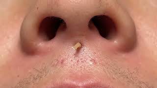 The ONE Blackhead Removal Secret You NEED to Know! ✨