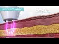 dermaspark academy trilipo technology for body contouring cellulite butt lift and more 2 version