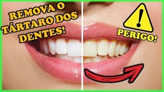 Tártaro no dente como remover?