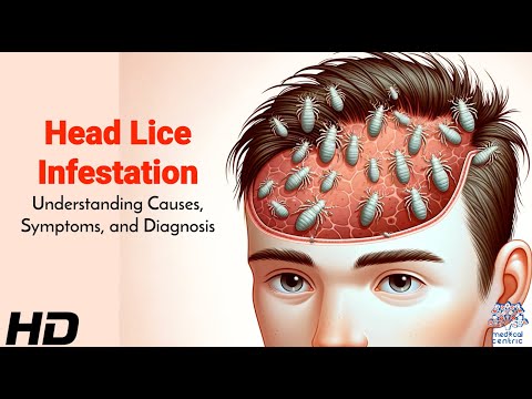 Can head lice cause eosinophilia?