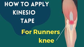 Kinesiology taping for patellofemoral syndrome (Knee pain)
