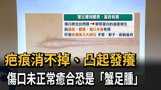 疤痕消不掉、凸起發癢　傷口未正常癒合恐是「蟹足腫」－民視新聞