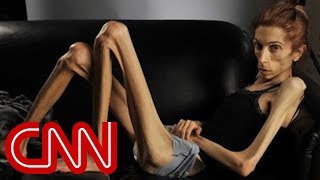 Anorexic woman's dramatic transformation