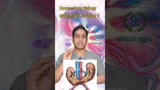 Horseshoe kidney என்றால் என்ன|லாடம் போல் உள்ள சிறுநீரகம்|Horseshoe kidney|Congenital Kidney problem