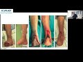 ICOPLAST Lower limb reconstruction diabetic ulcers; intro and reason for microsurgery to salvage