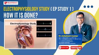 Electrophysiology study ( EP Study 1) How it is done? | Dr Ashutosh Kumar