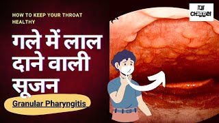 Granular pharyngitis | Gale me Lal daane hona | गले में लाल दाने वाली सूजन। गले का ख़राब रहना।