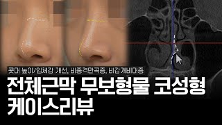 콧대에 전체근막으로 입체감 준 무보형물 코성형 4개월 전후 | 비중격만곡증, 비갑개비대증 | 기능코수술  CT 비교분석