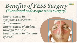 Benefits of FESS Surgery