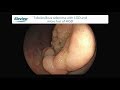 Piecemeal Endoscopic Mucosal Resection with Eleview™